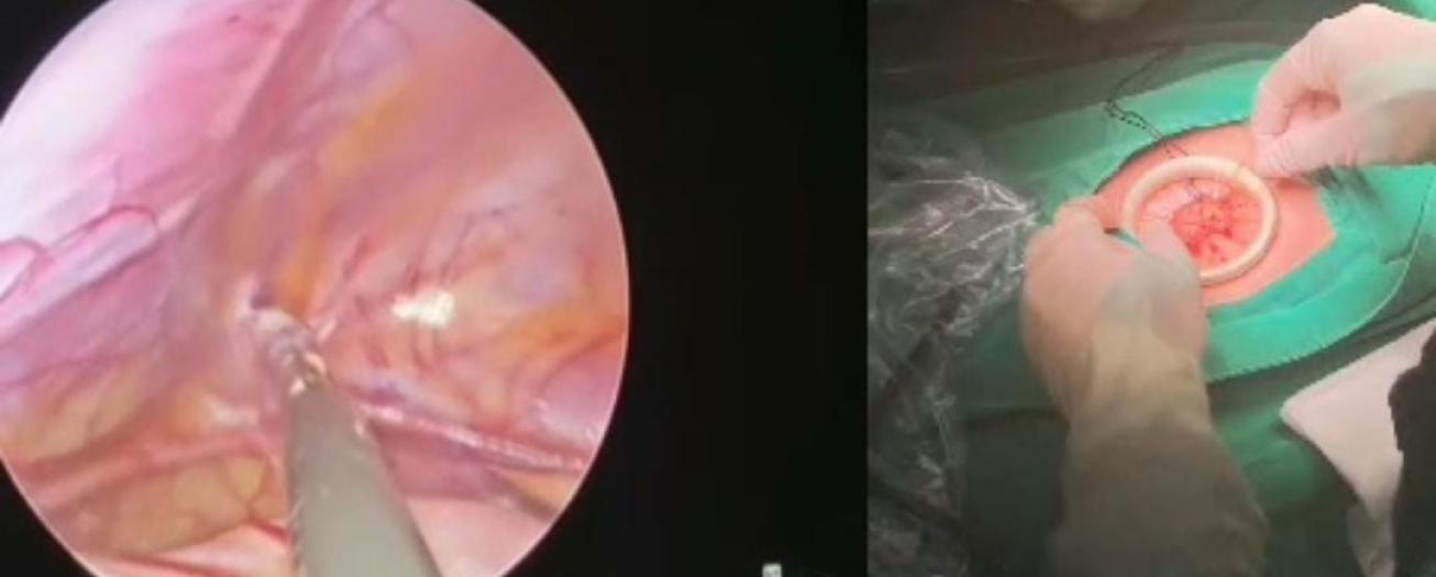 Hospital de San Ramón opera hernias inguinales en niños con procedimiento laparoscópico que utiliza una sola incisión umbilical